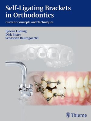 cover image of Self-Ligating Brackets in Orthodontics